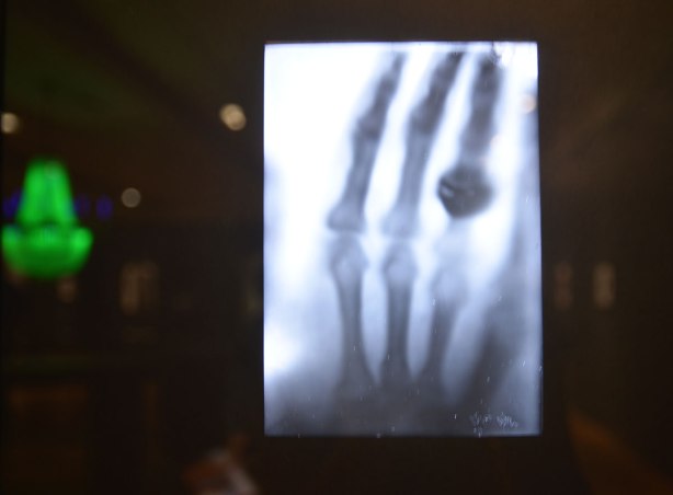 An xray picture of a hand. 